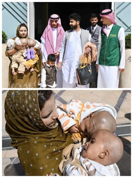 Saudi Arabia’s Global Leadership in Conjoined Twin Surgeries